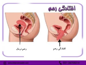 افتادگی رحم - دکتر درویش زاده