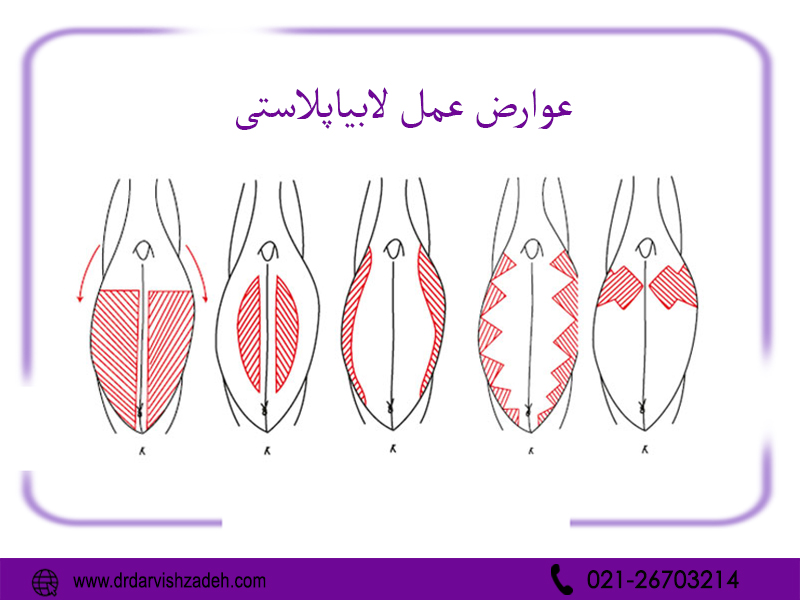 عوارض عمل لابیاپلاستی - دکتر درویش زاده