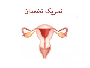 تحریک تخمدان - دکتر درویش زاده