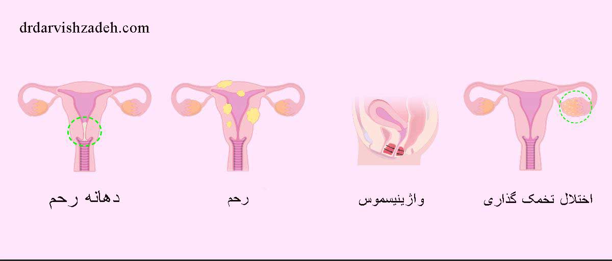 واژینسموس - دکتر درویش زاده