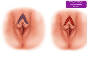 جراحی زیبایی کلیتوریس - دکتر درویش زاده