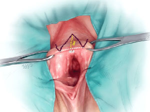 پرینورافی - دکتر درویش زاده