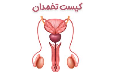 کیست تخمدان + علائم و روش های درمان