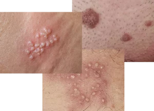 زگیل تناسلی - دکتر درویش زاده