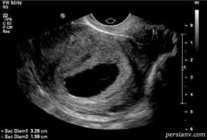 بارداری پوچ - دکتر درویش زاده