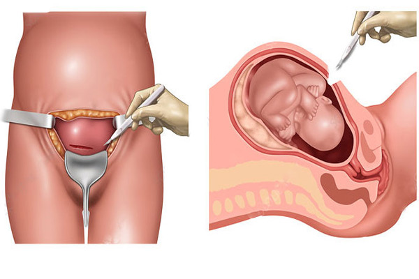 زایمان سزارین در تهران - دکتر درویش زاده