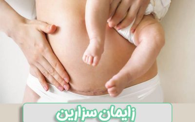 زایمان سزارین