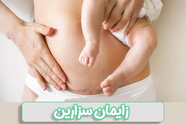 زایمان سزارین در تهران - دکتر درویش زاده