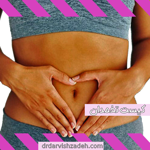 کیست تخمدان