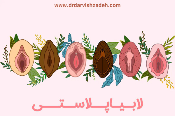 لابیاپلاستی - دکتر درویش زاده