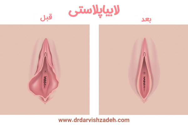 قبل و بعد از لابیاپلاستی - دکتر فرزانه درویش زاده