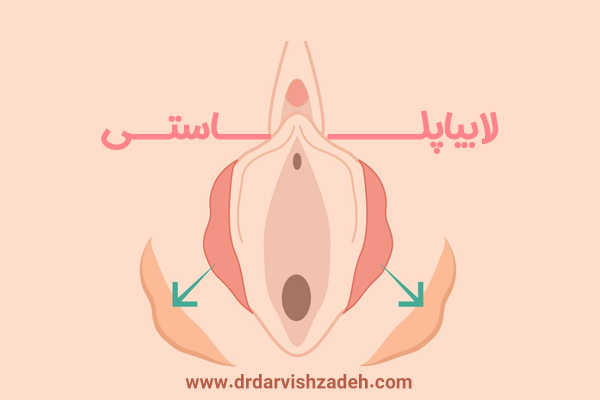 لابیاپلاستی - دکتر درویش زاده