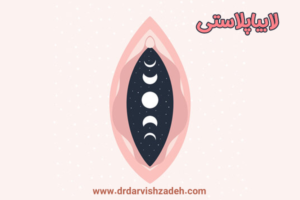لابیاپلاستی - دکتر درویش زاده