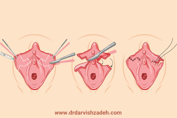 لابیاپلاستی - دکتر درویش زاده