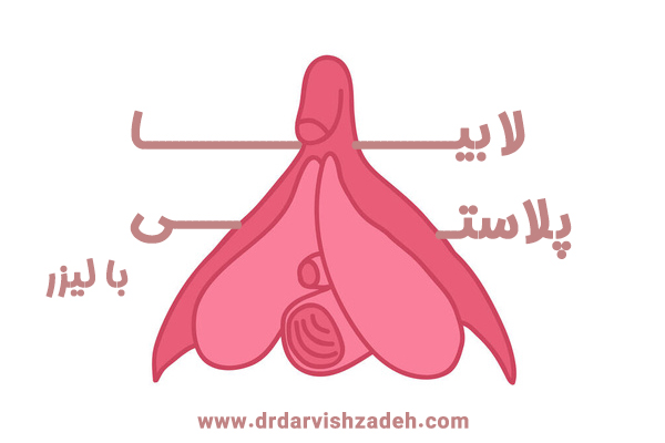 لابیاپلاستی با لیزر - دکتر فرزانه درویش زاده 