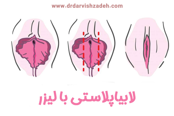 لابیاپلاستی با لیزر - دکتر فرزانه درویش زاده
