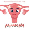 زخم دهانه رحم - دکتر فرزانه درویش زاده