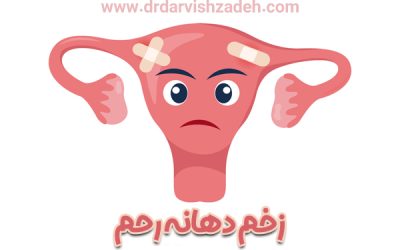 زخم دهانه رحم + نشانه های پیدایش