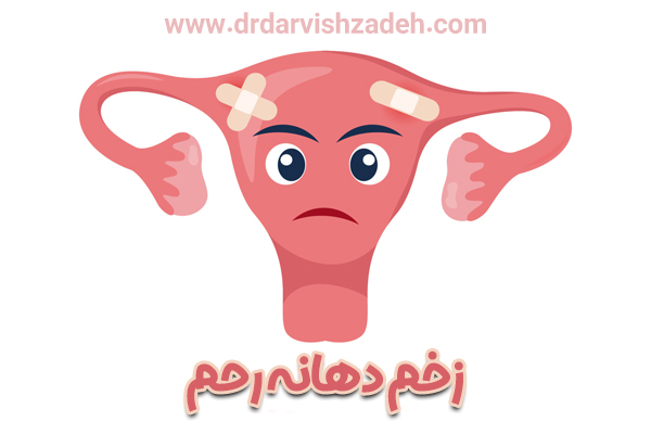 زخم دهانه رحم - دکتر فرزانه درویش زاده 