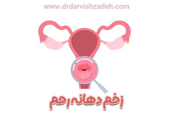 زخم دهانه رحم - دکار فرزانه درویش زاده 