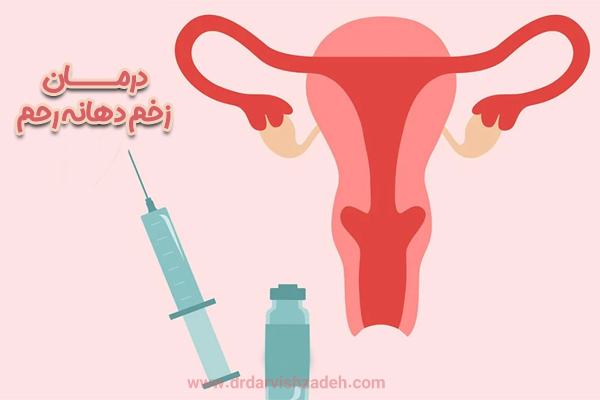 درمان زخم دهانه رحم - دکتر فرزانه درویش زاده