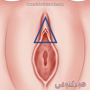 هودکتومی یا هودوپلاستی در تهران - دکتر فرزانه درویش زاده