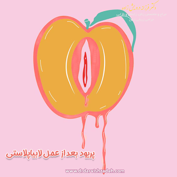 پریود بعد از عمل لابیاپلاستی - دکتر فرزانه درویش زاده