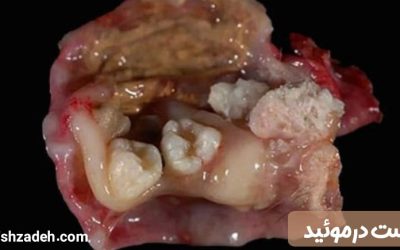 درمان کیست درموئید توسط بهترین متخصص زنان در تهران