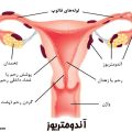 آندومتریوز