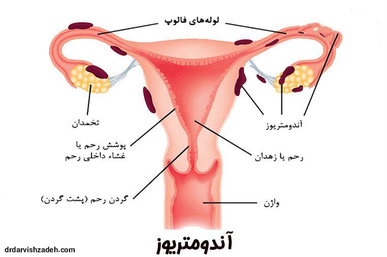 آندومتریوز