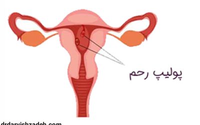 پولیپ رحم | از علل تا راه های درمان آن