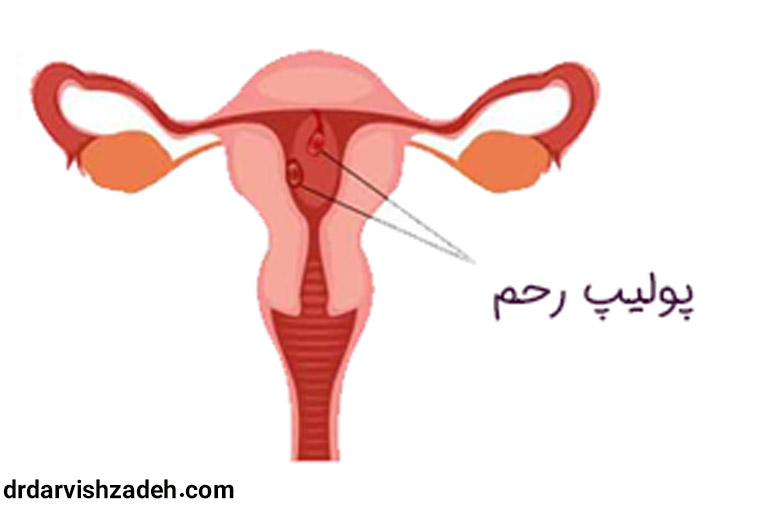 پولیپ رحم