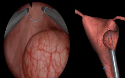 میومکتومی با روش هیستروسکوپی