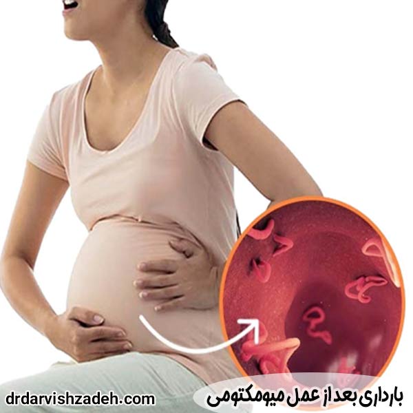 بارداری بعد از عمل میومکتومی