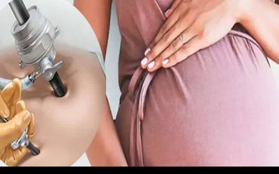 لاپاراسکوپی در بارداری