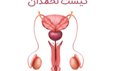 کیست تخمدان + علائم و روش های درمان