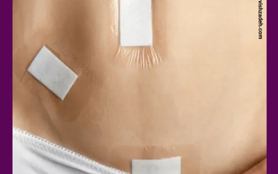 مراقبت های بعد از لاپاراسکوپی