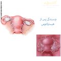 چسبندگی بعد از هیسترکتومی - دکتر درویش زاده