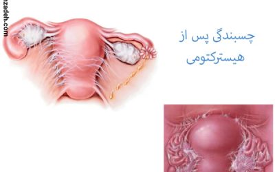 چسبندگی بعد از هیسترکتومی
