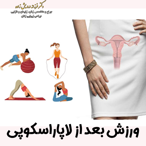 ورزش بعد از لاپاراسکوپی